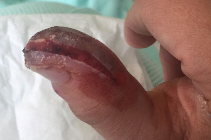 PIC FROM Caters News - (PICTURED: Cherie Newmans nail after her first operation) - A mum of four lost the top of her thumb after a fake nail caused deadly blood poisoning. Cherie Newman, 33, treated herself to a set of acrylic nails in July but after leaving them for four weeks, she decided to try and remove them herself. After buying some nail remover, Cherie accidently tore her real thumb nail and caused it to bleed. The mum of four visited the doctors for something unrelated one month later and was then urged to seek urgent hospital treatment as the tip of her thumb had turned purple.SEE CATERS COPY