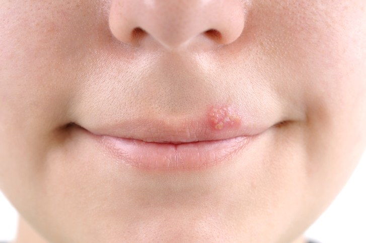 снимка of a person with a cold sore from herpes simplex virus 1