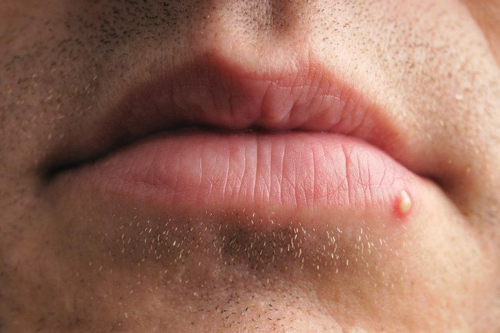 пъпка or zit on the lips on the lip area of a person.