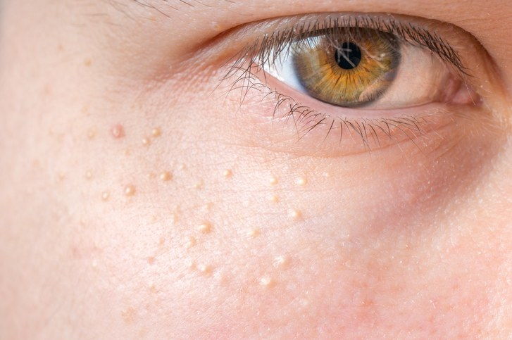 ميليا (Milium) - البثور حول العين على الجلد