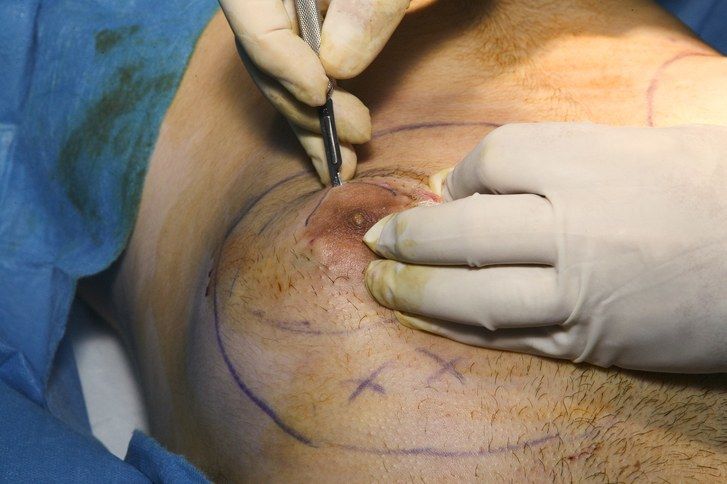 مريض من الذكور يخضع لجراحة تصغير الثدي
