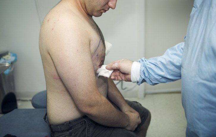 Mannliche Brustverkleinerung Mehr Manner Die Chirurgie Fur Gynakomastie Erhalten