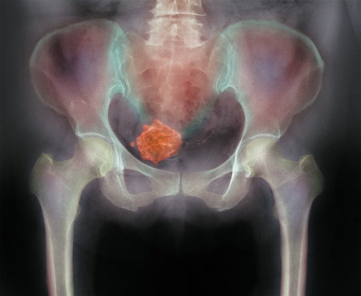 Röntgenbild des Uterusmyomids