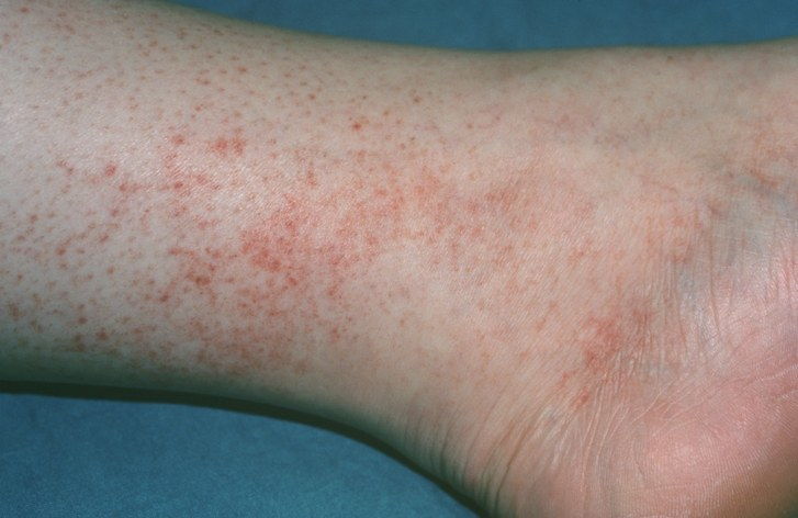 Rocky Mountain Spotted Fever rash on the ankle