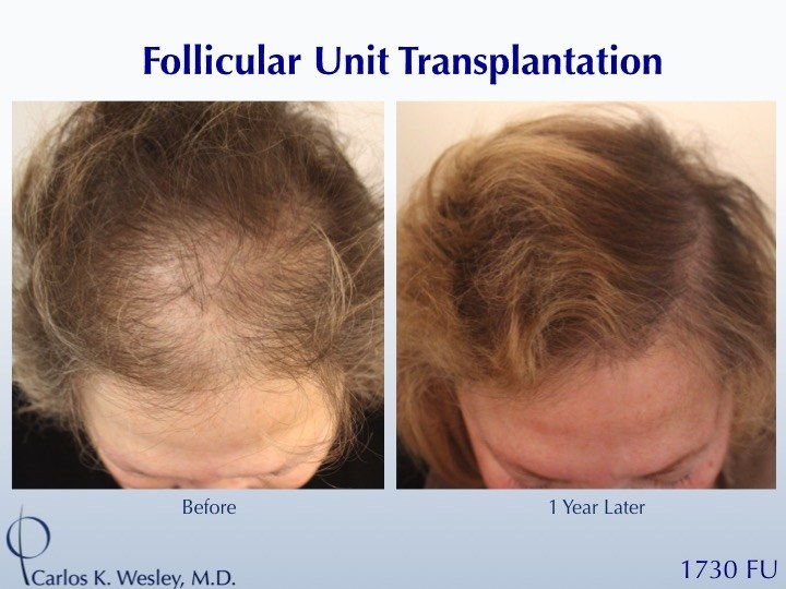 коса follicle transplant before after