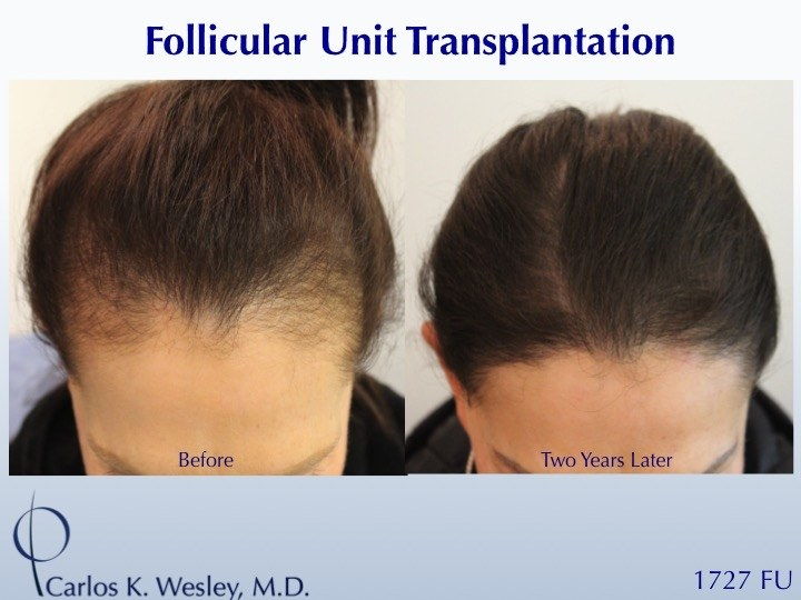 коса transplant follicle before and after
