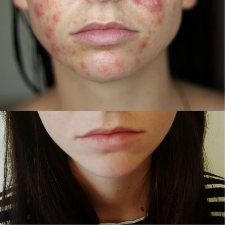 blogger alice lang before and after acne photos 