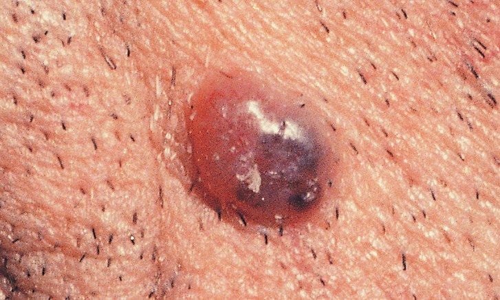 سرطان الخلايا القاعدية سرطان الجلد