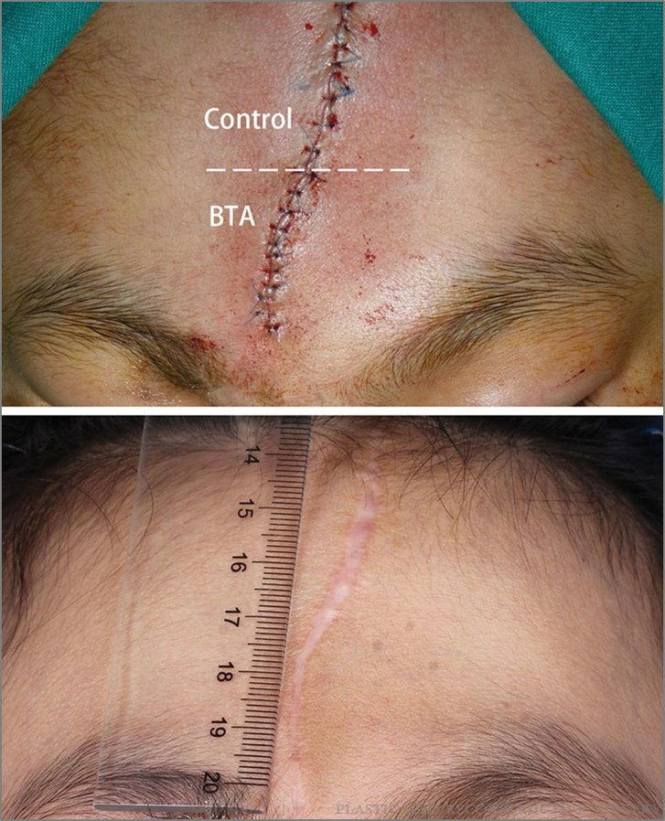 Vorher und nachher Bild des Patienten mit Botox-Injektionen in Gesichtsnarbe