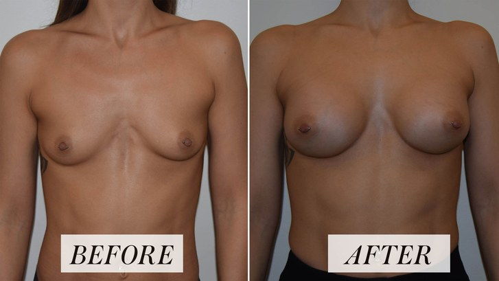 Frau's before-and-after photos of breast augmentation procedure