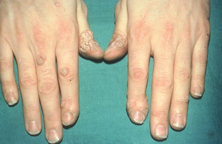 Индивидуален with common warts on fingers and thumbs