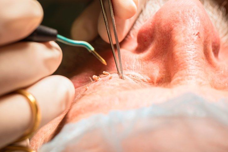 Лекар removing man's filiform warts from eyelid