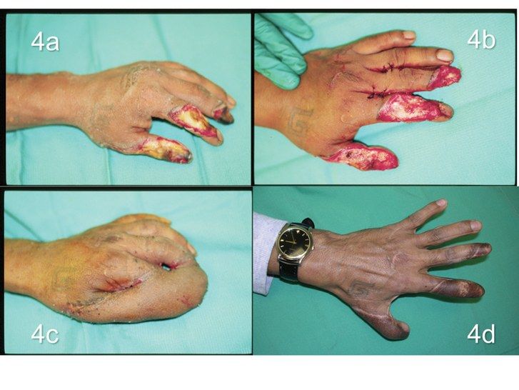 Снимки of man with fourth-degree burns on hand