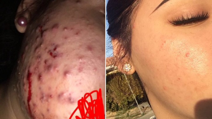 před and after photos of teen cystic acne
