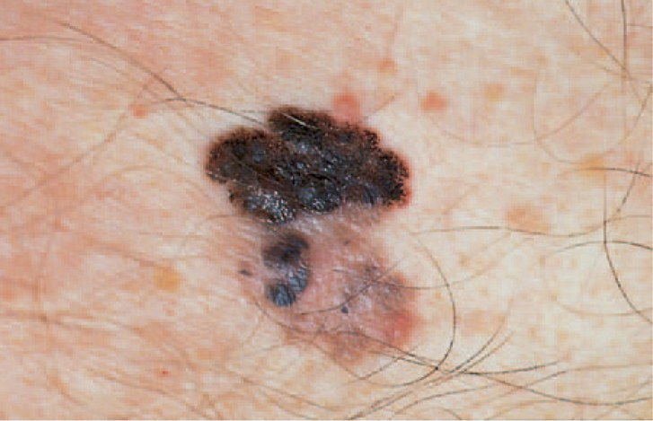 سرطان الجلد الميلانيني