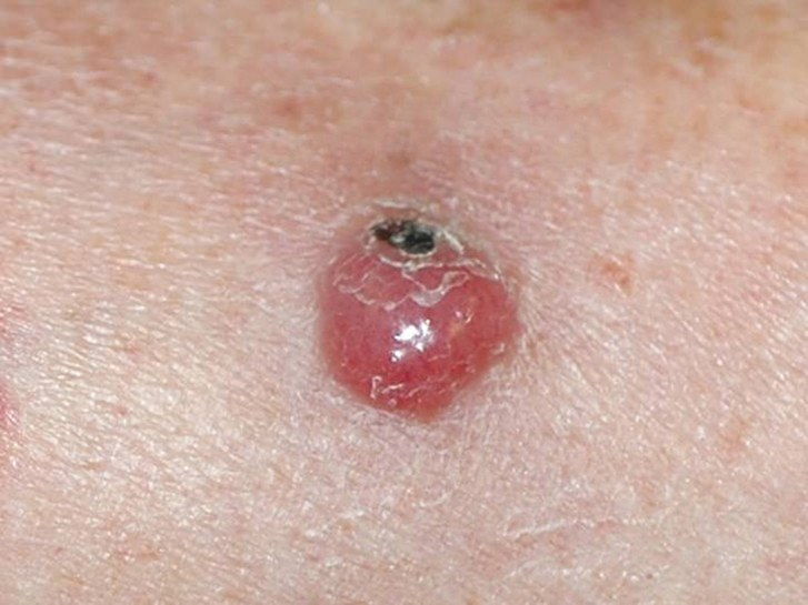 默克尔细胞癌皮肤癌