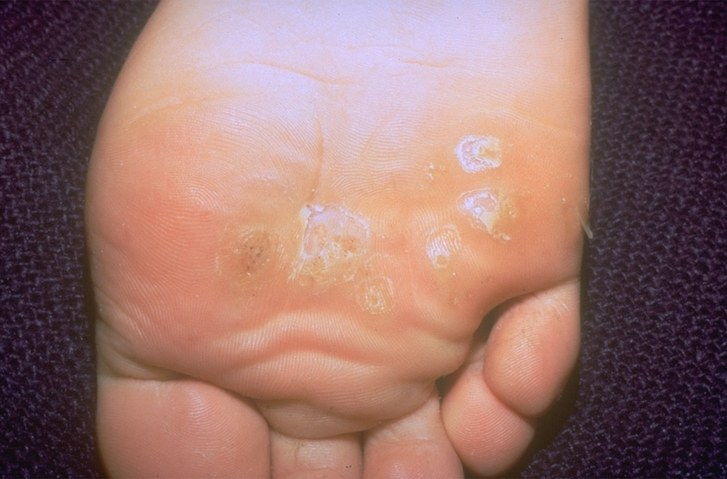 فرد's foot with plantar warts