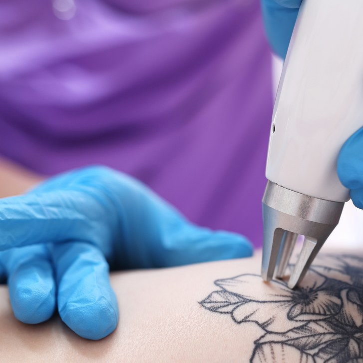 Лекар removing individual's tattoo with laser device