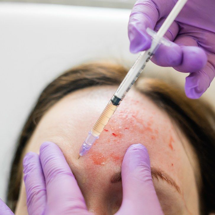 жена getting platelet rich plasma (PRP) injected into forehead