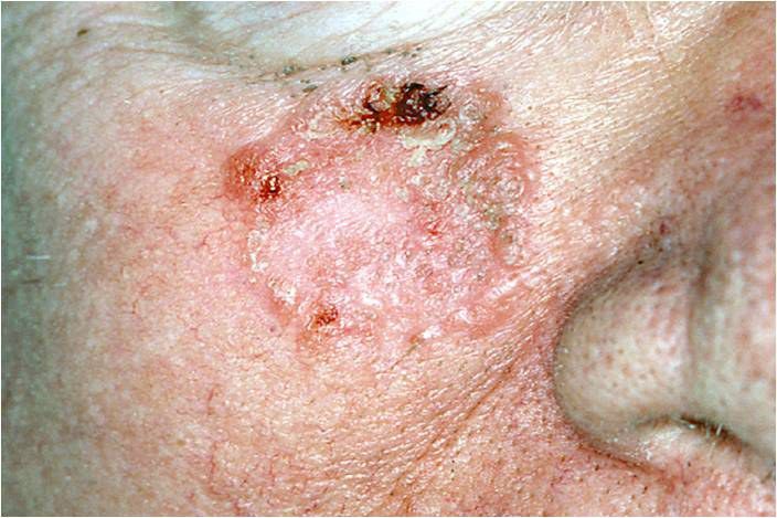 سرطان الخلايا الحرشفية سرطان الجلد
