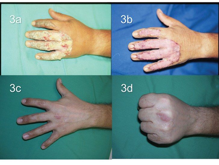 Снимки of third-degree burns on hands