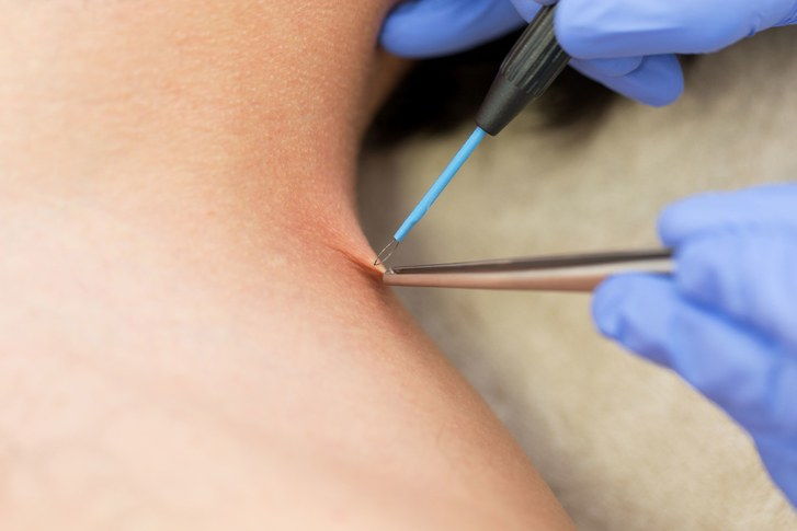 Лекар removing wart from individual's shoulder with electric tool